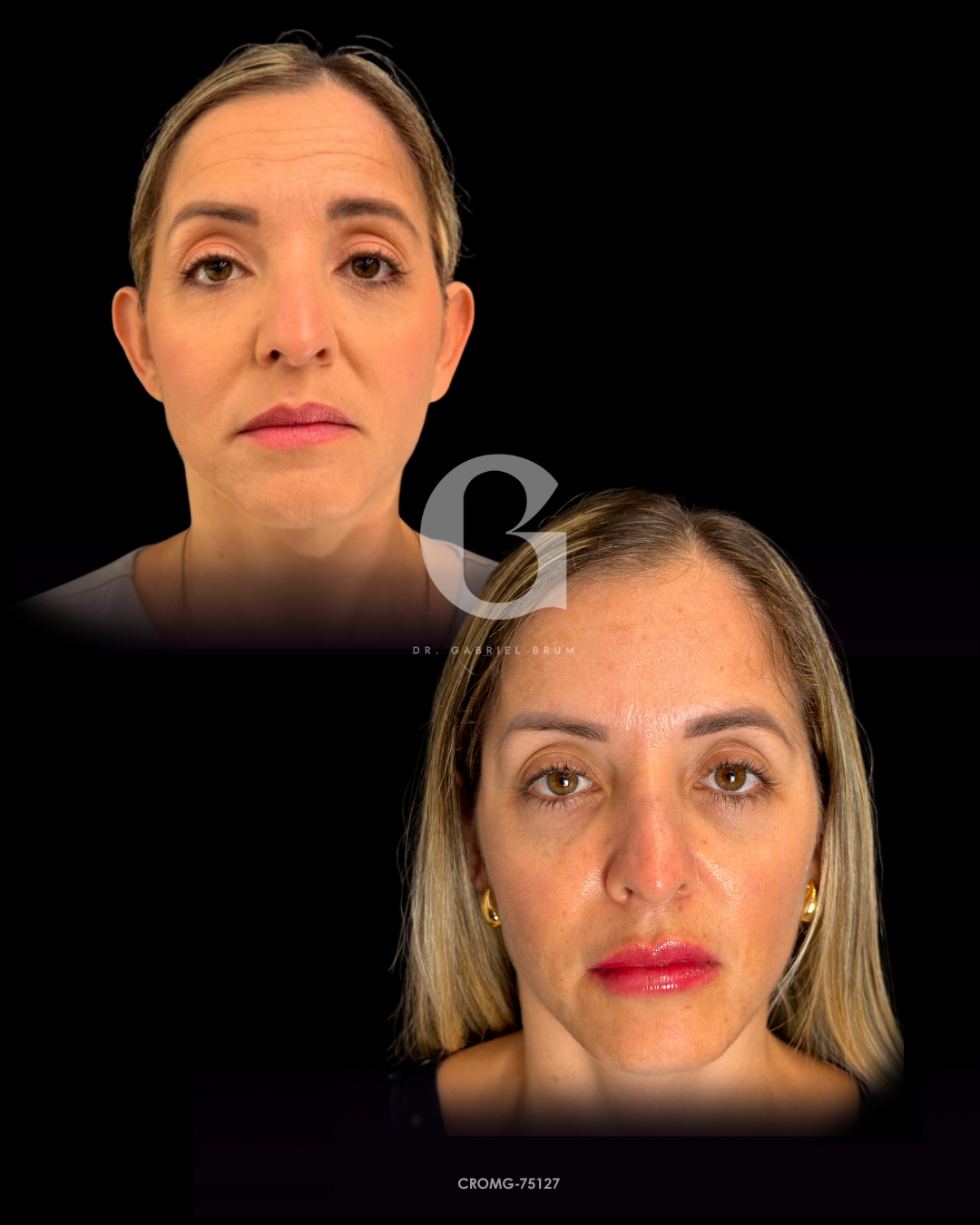 Registro frontal da paciente